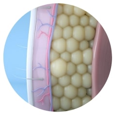 Reduced fat cells after CoolSculpting treatment.