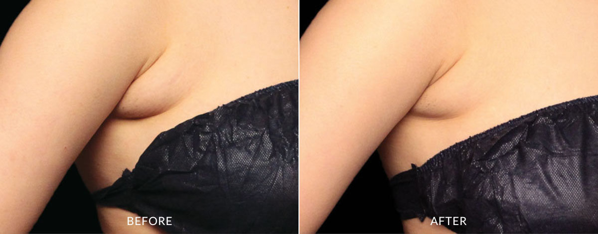 Coolsculpting Elite before and after photo showing a reduced fat in the armpit area of a woman.